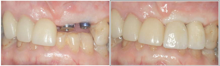 Dental implants Armidale NSW