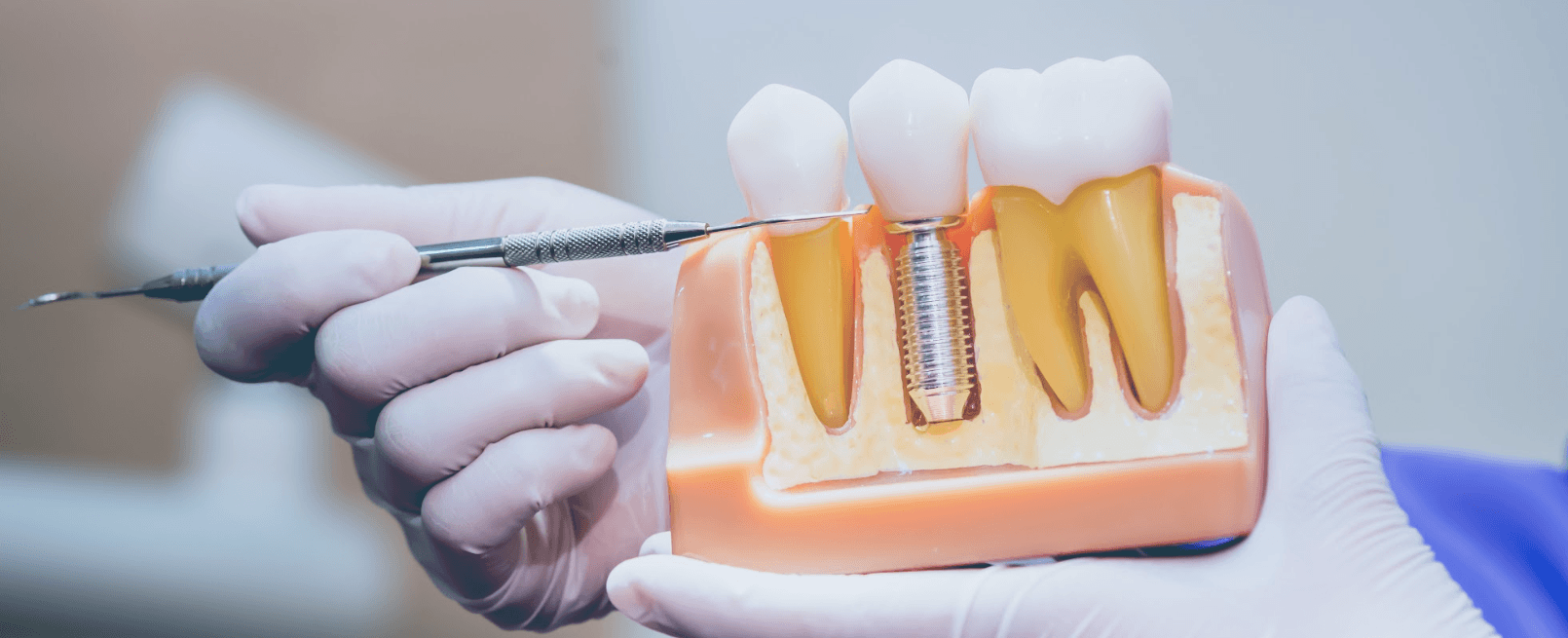 Dental implant shown by a dentist in Armidale NSW