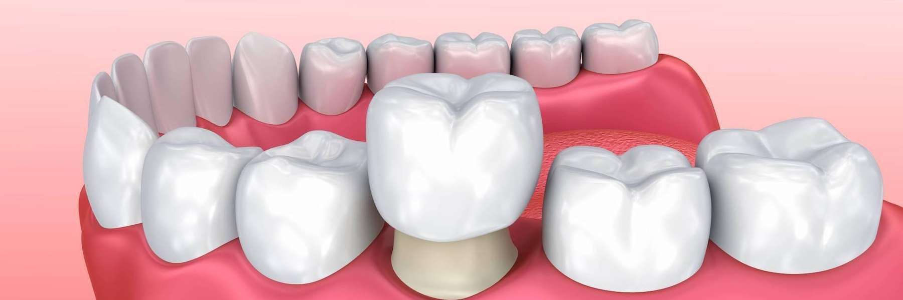 Close-up of dental implant with crown and tooth, symbolizing emergency crowns for urgent dental care