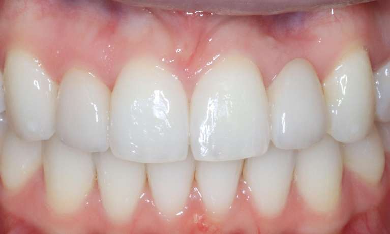 Braces Armidale Dentist