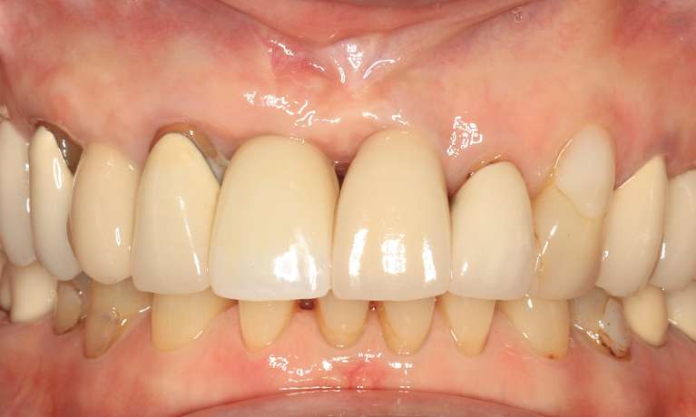 Dental Implants Armidale