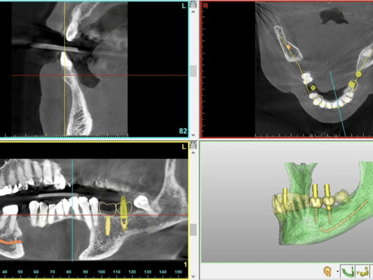 Simplant implant planning software